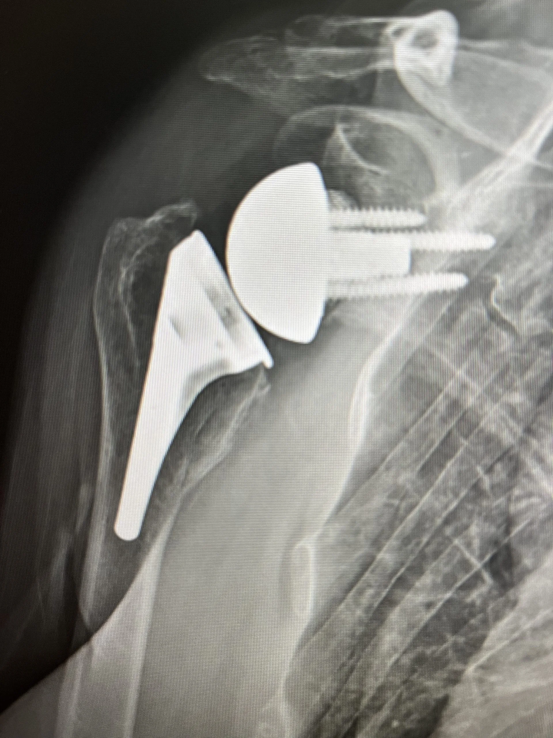 Reverse Shoulder Replacement (1)