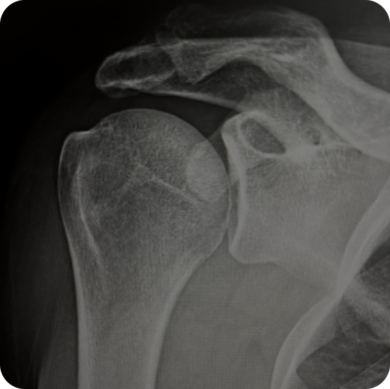 Normal Shoulder 1