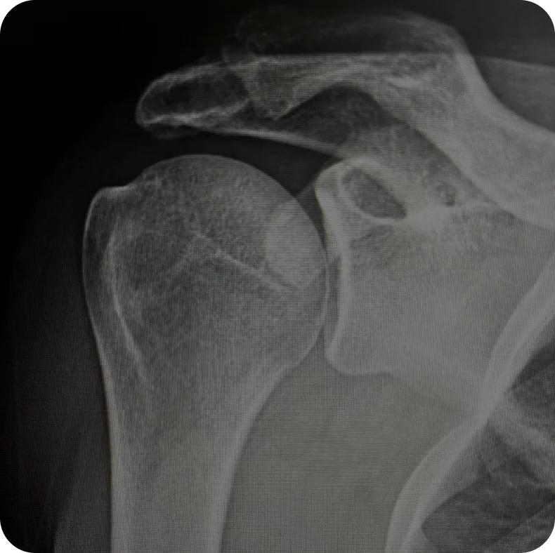 Normal Shoulder 1 Normal Shoulder 1