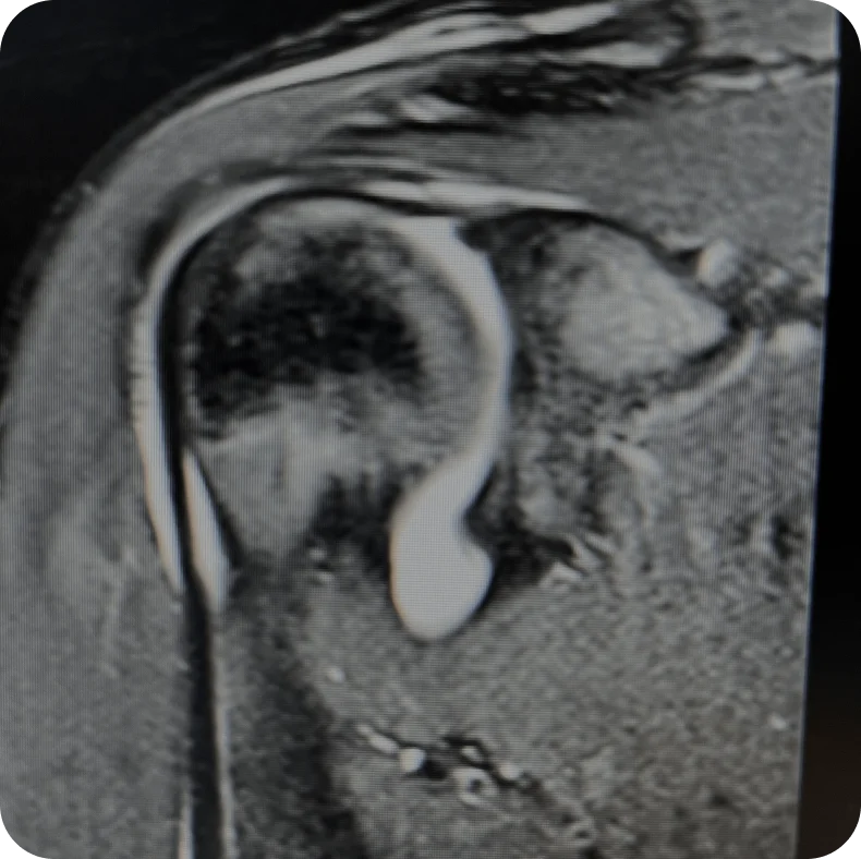 Normal Superior Labrum (Glenoid)