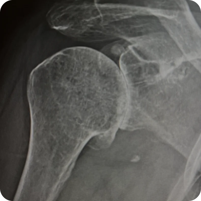 Shoulder-Arthritis-1-scaled 1