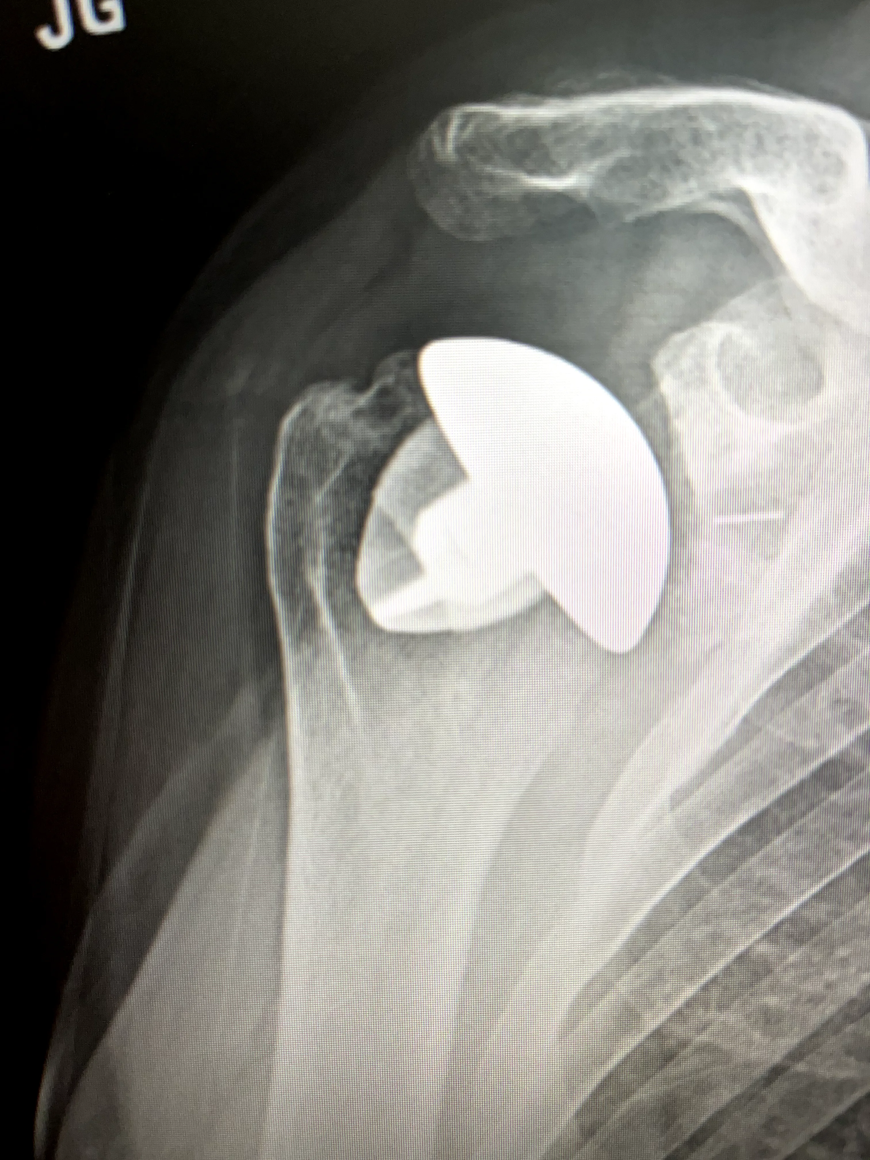 Shoulder Replacement (6) 1